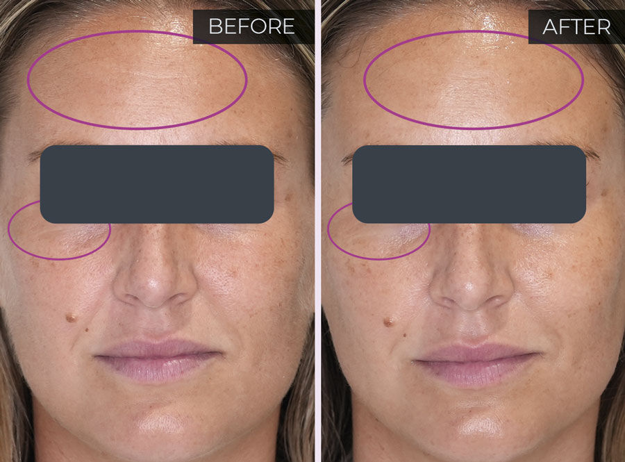 Imagen eficacia probada antes y después mascara BTSES Mimetic