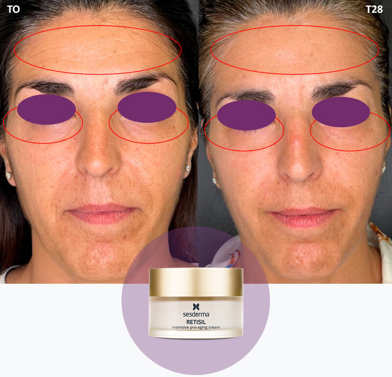 Imagen mujer eficacia antes/después crema facial Retisil