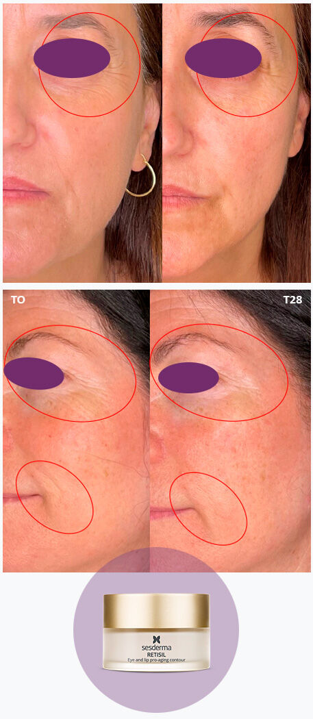 Imagen mujer eficacia antes/después crema contorno ojos Retisil