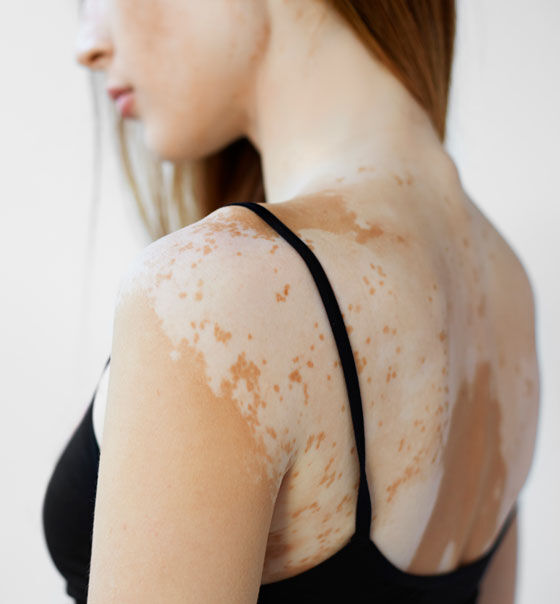 Research and development of new functionalized liposomes for the treatment of vitiligo and psoriasis