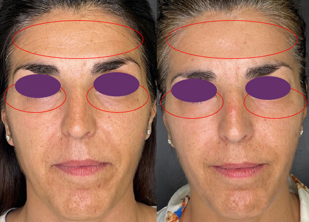 Imagen mujer eficacia antes/después crema facial Retisil