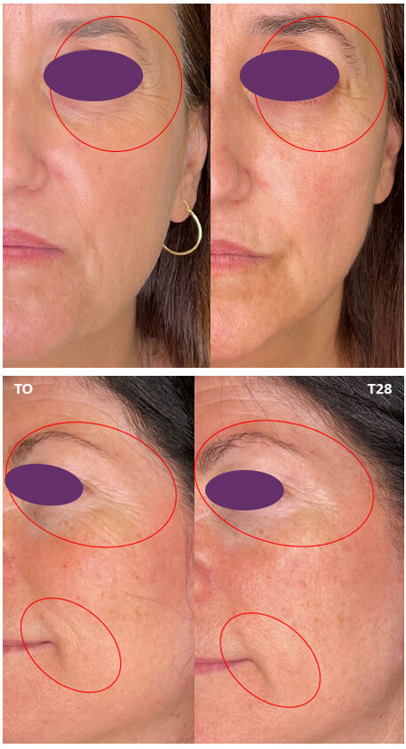 Imagen mujer eficacia antes/después crema contorno ojos Retisil