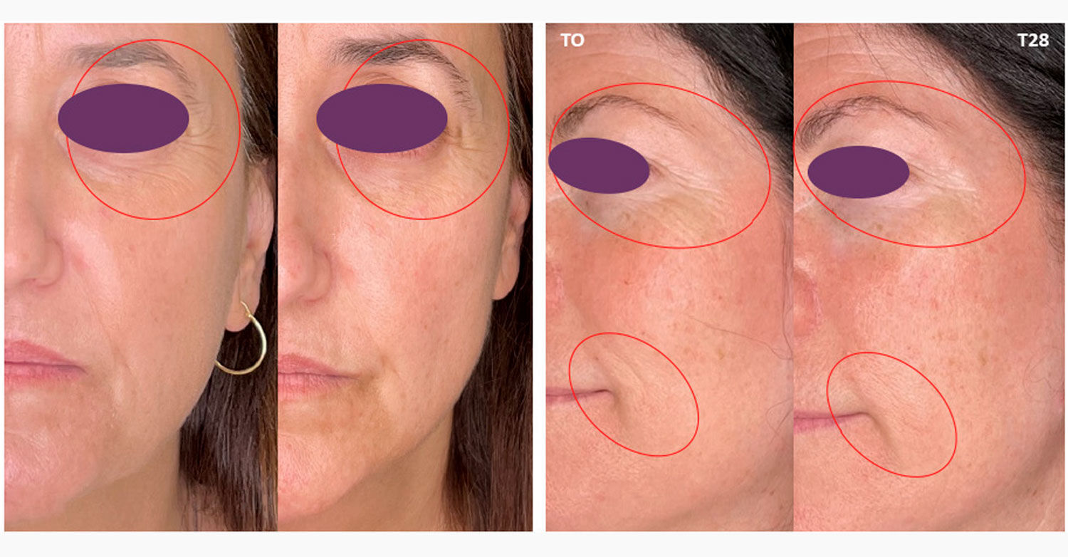 Imagen mujer eficacia antes/después crema contorno ojos Retisil